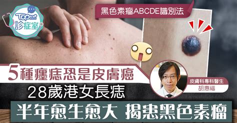 癦凸起|你要知： 臉上癦痣愈長愈大 黑色素定皮膚癌點識別？